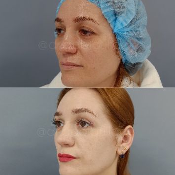 Круговая блефаропластика Краснодар