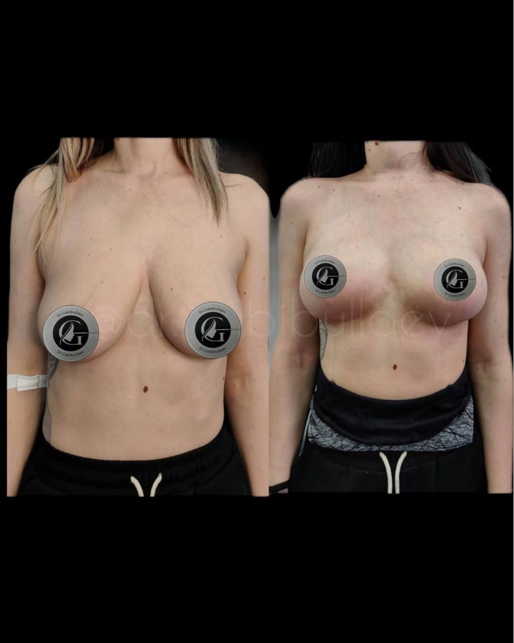 Якорная подтяжка груди