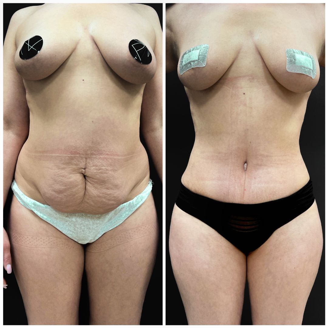 Абдоминопластика