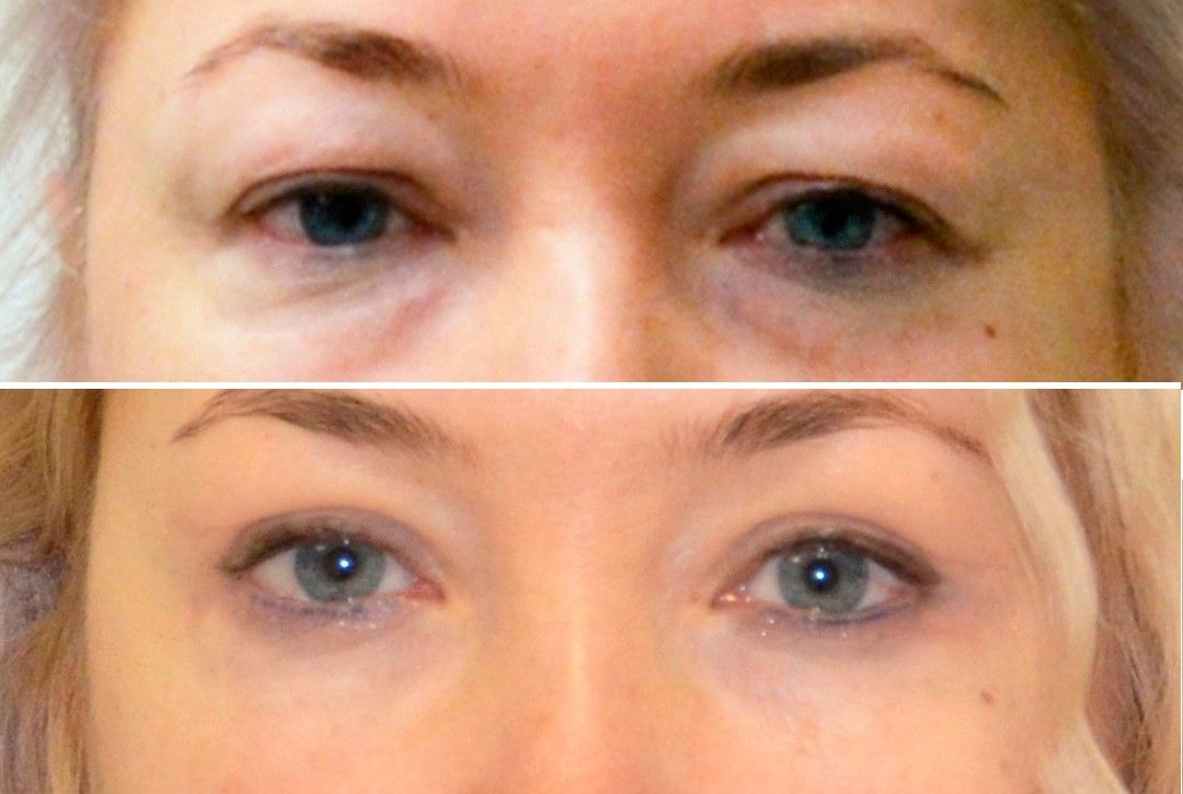 Круговая блефаропластика