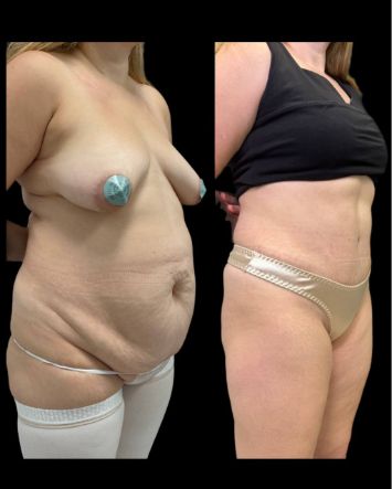 Абдоминопластика