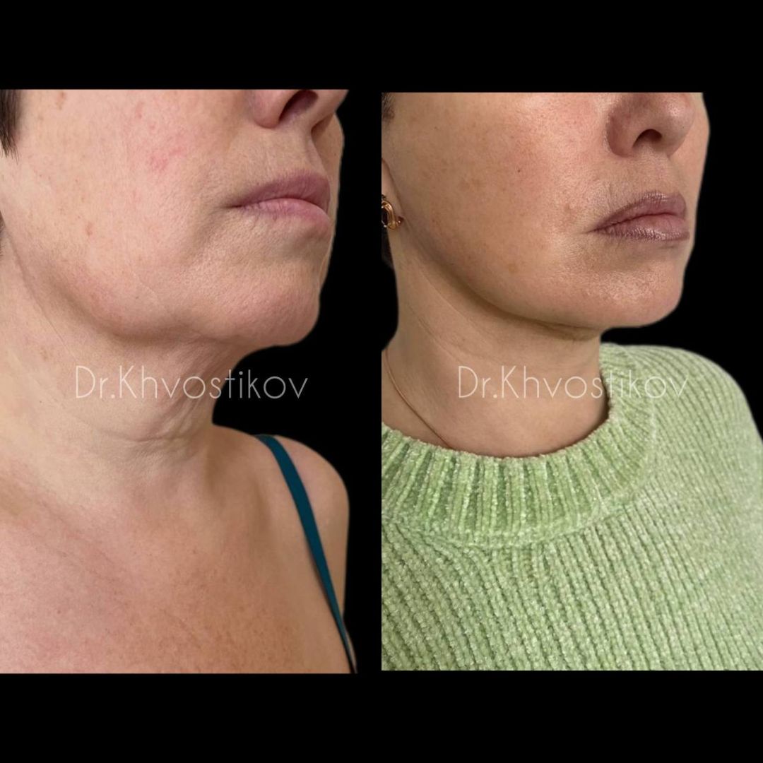 Фейслифтинг