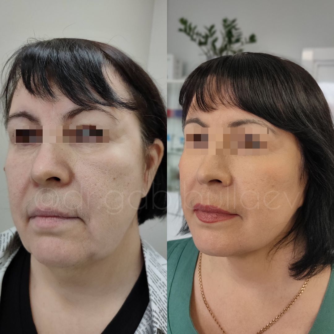 Подтяжка лица