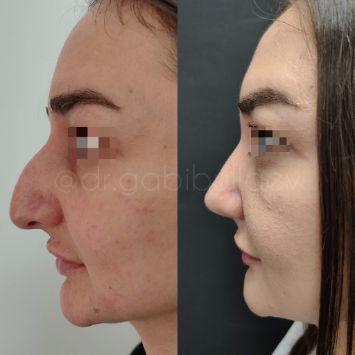 Ринопластика Краснодар