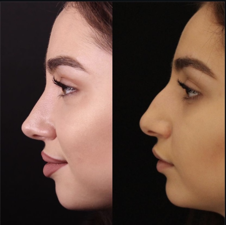 Ринопластика