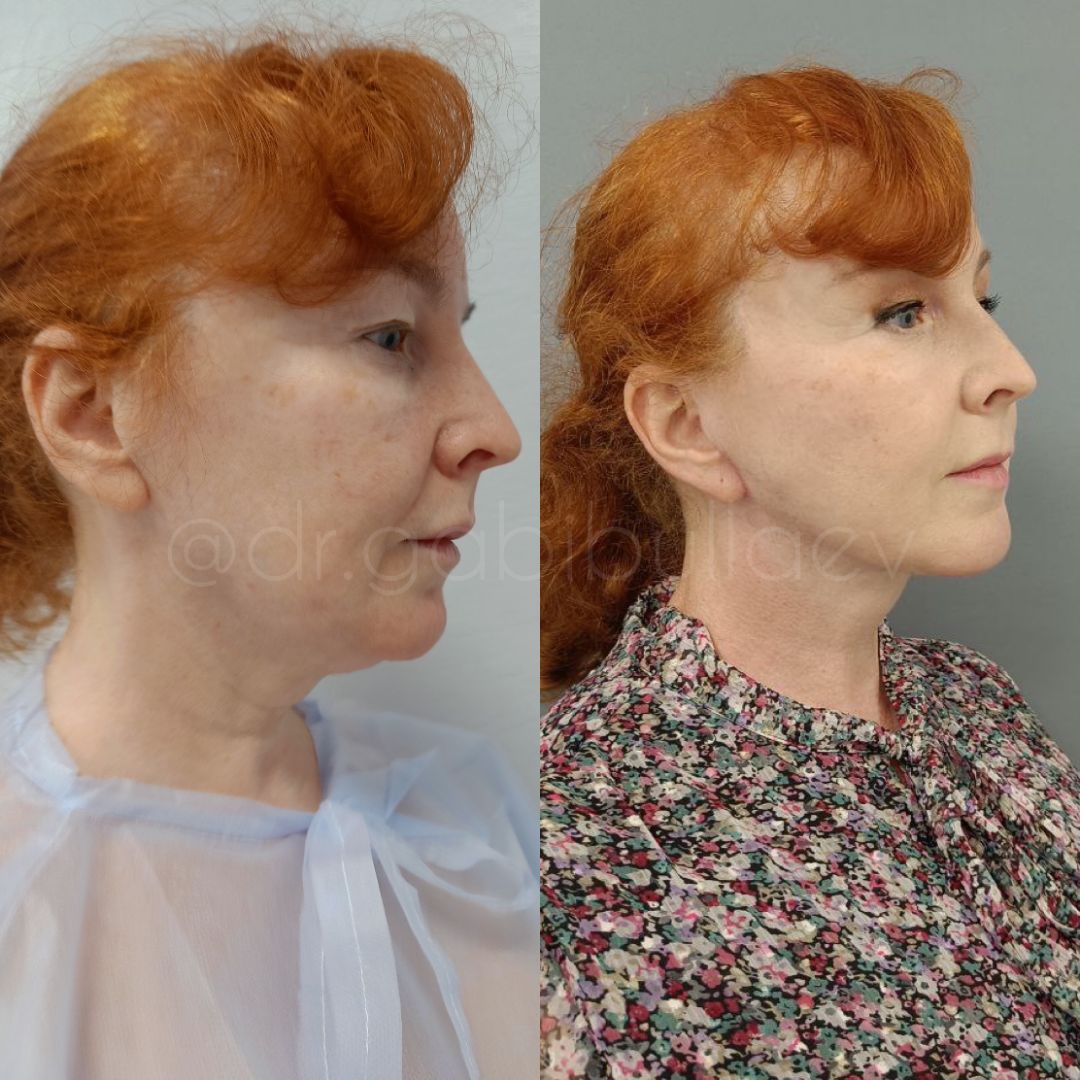 Подтяжка лица и шеи