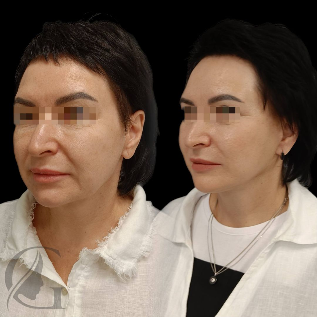 Подтяжка лица фейслифтинг