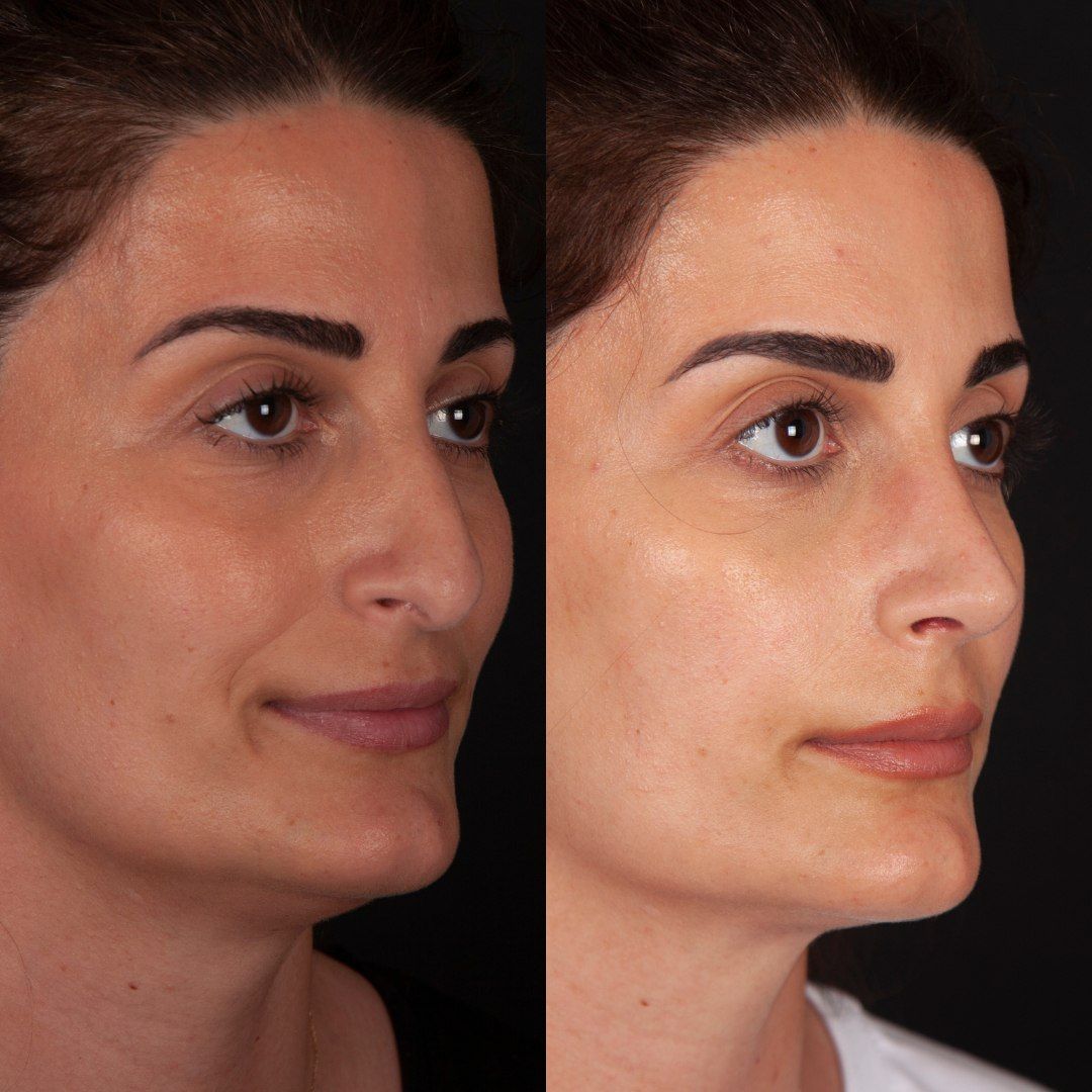 Риносептопластика Краснодар