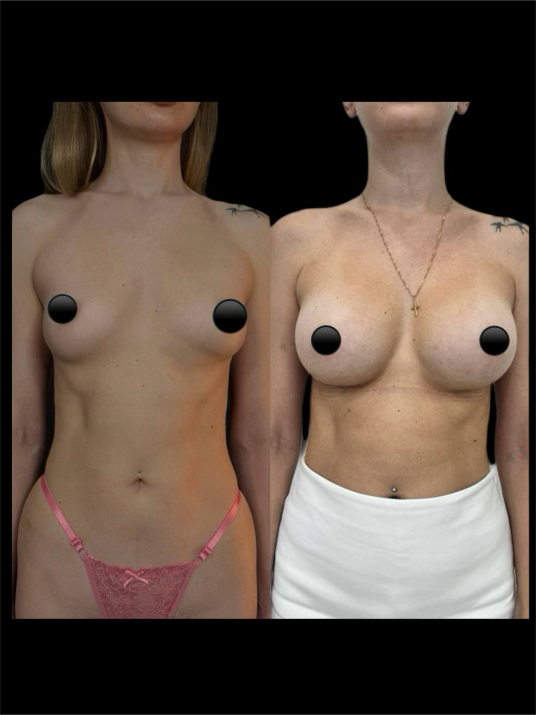 Увеличение груди имплантами