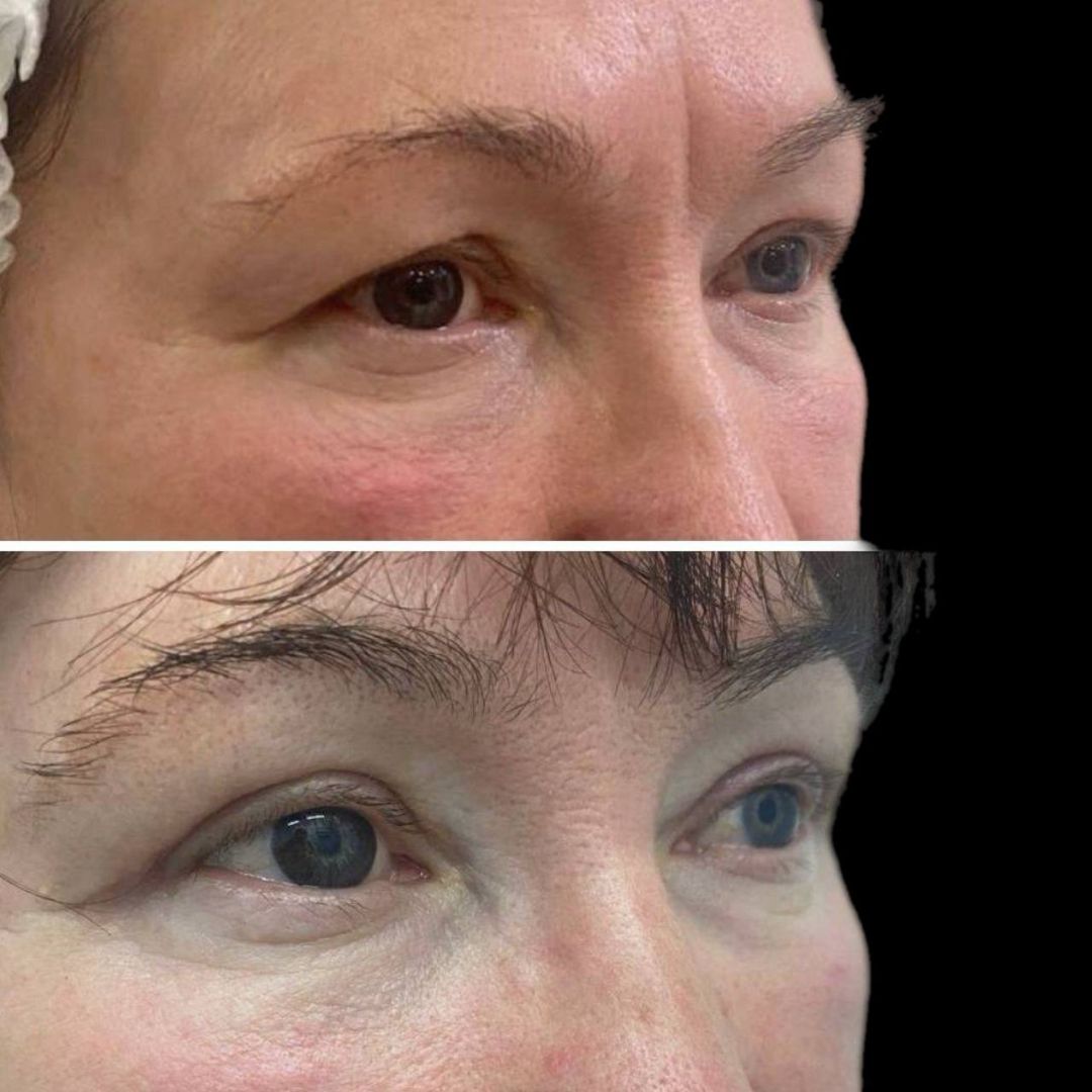 Верхняя блефаропластика