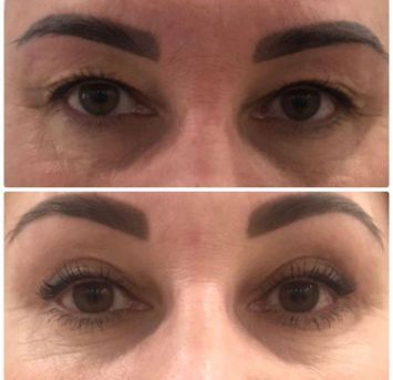 Блефаропластика Краснодар