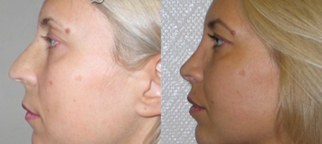 Верхняя блефаропластика