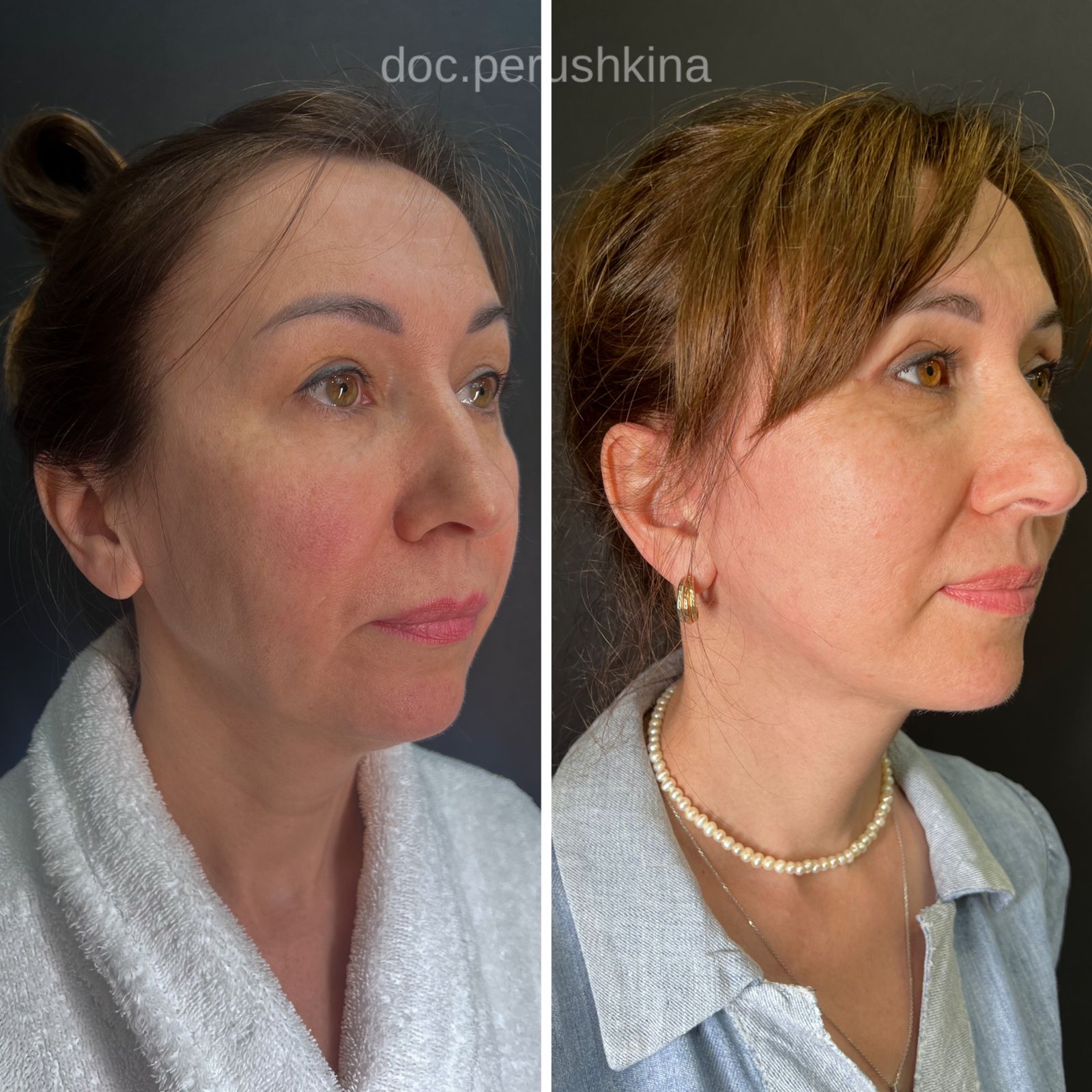 Фейслифтинг