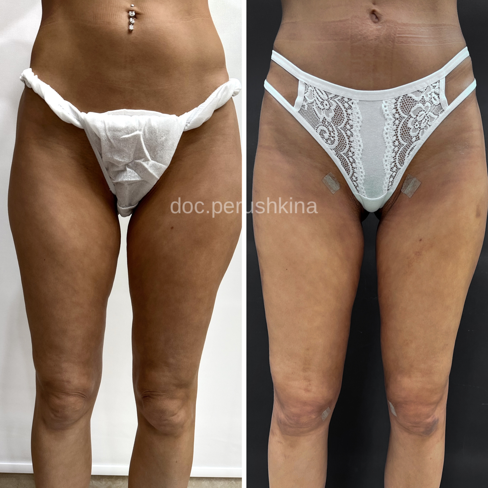 Липосакция