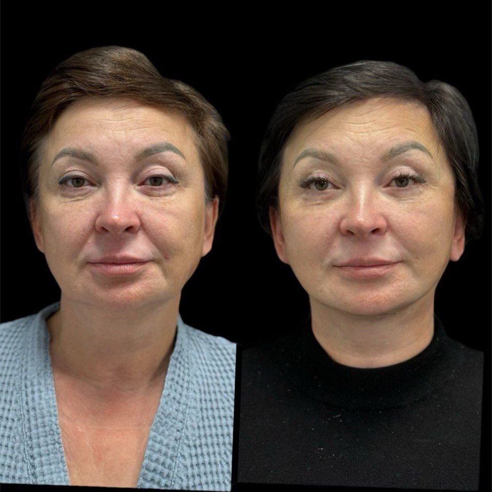 Смас-лифтинг