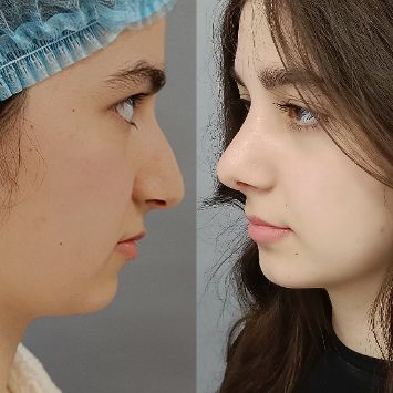 Риносептопластика