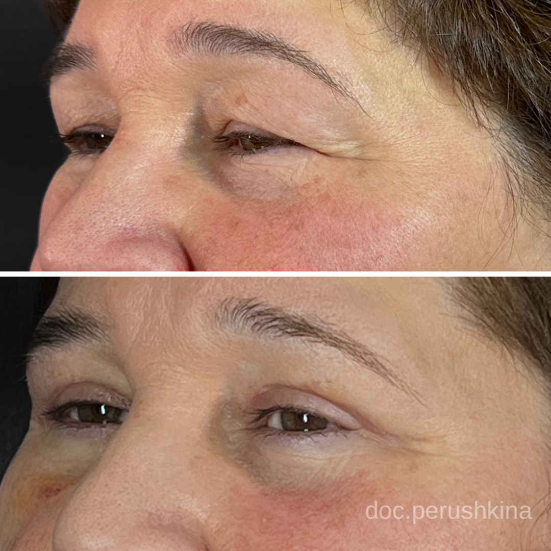 Круговая блефаропластика