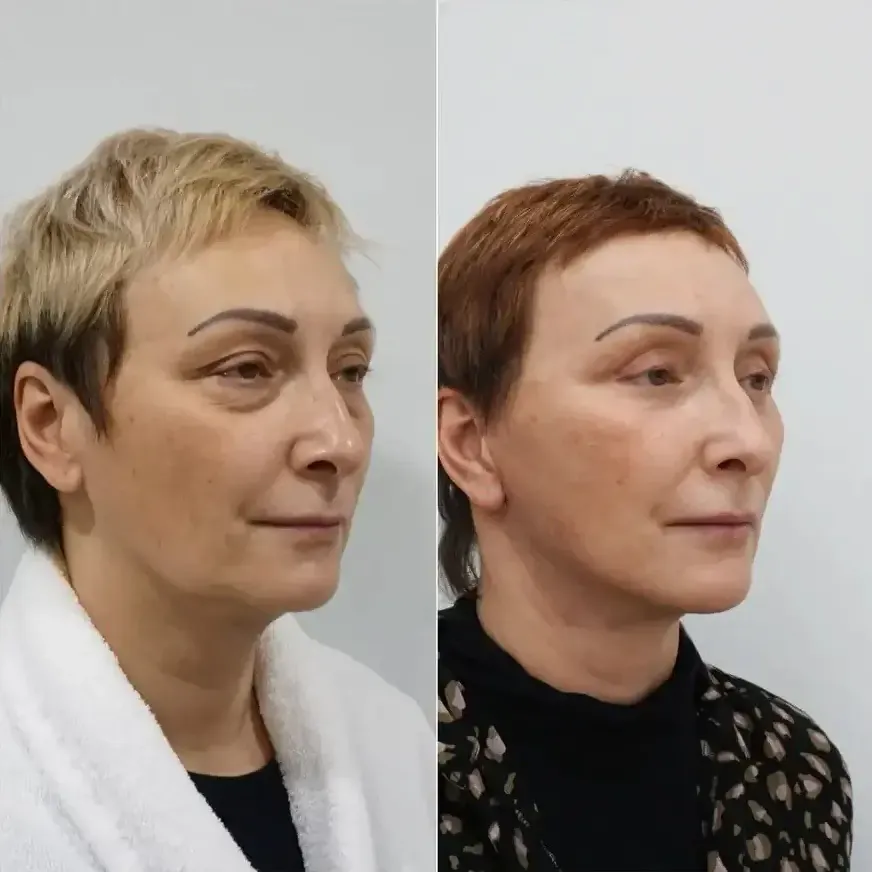 Пример работы доктора Мельникова Дмитрия Александровича в области ринопластики.