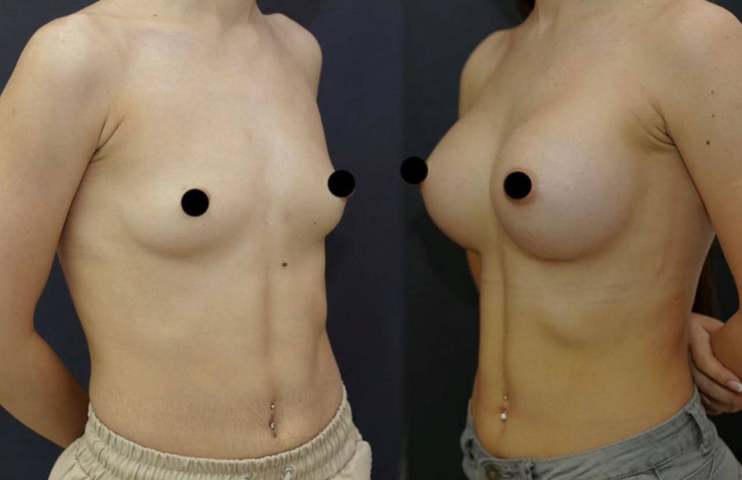 Эндопротезирование молочных желез