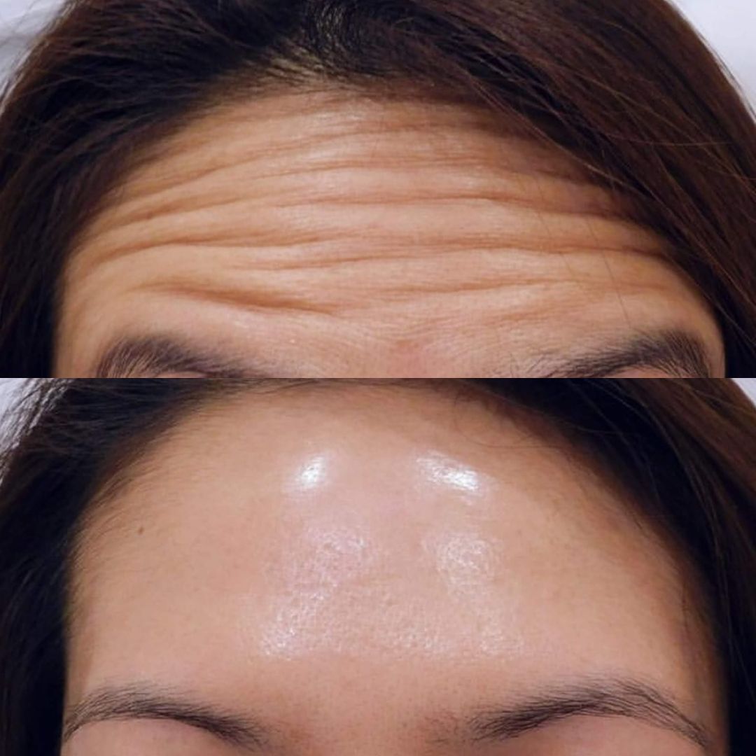 Ботулинотерапия Краснодар