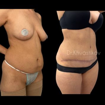 Ушивание диастаза Краснодар