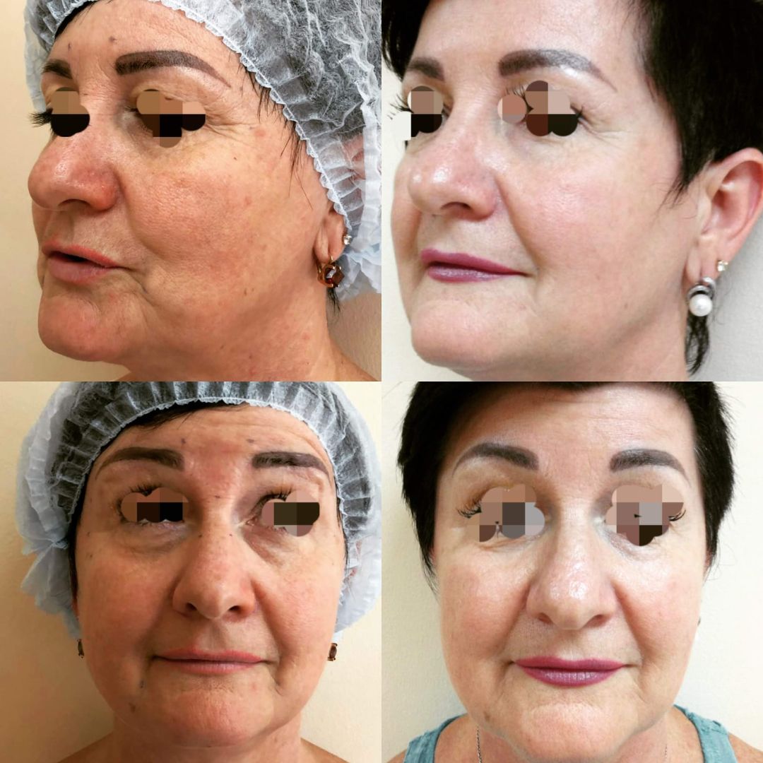 Мезотерапия Краснодар