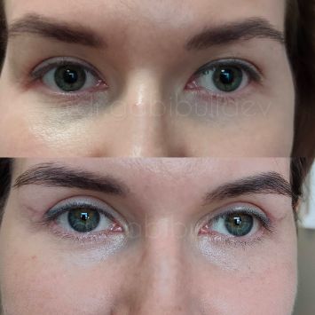 Верхняя блефаропластика