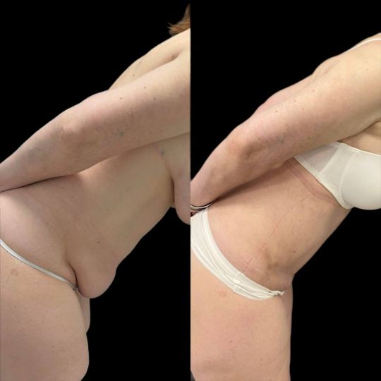 Липосакция живота Краснодар