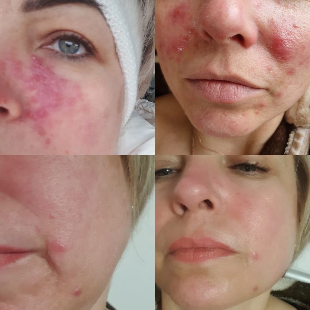 Лечение розацеа