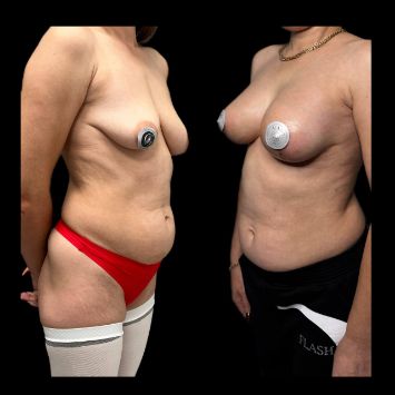 Маммопластика, подтяжка груди с увеличением