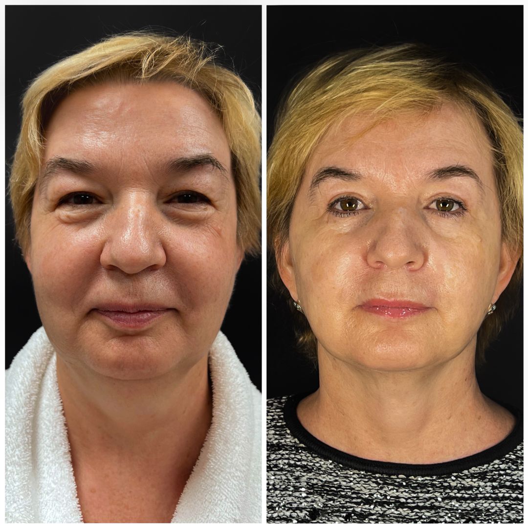 Блефаропластика