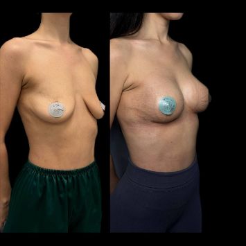 Подтяжка груди с увеличением