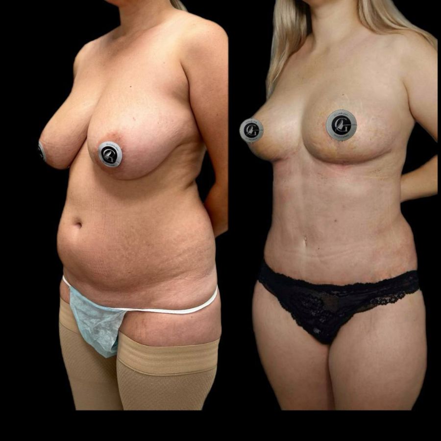 Абдоминопластика подтяжка груди