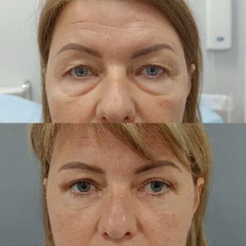 Блефаропластика Краснодар