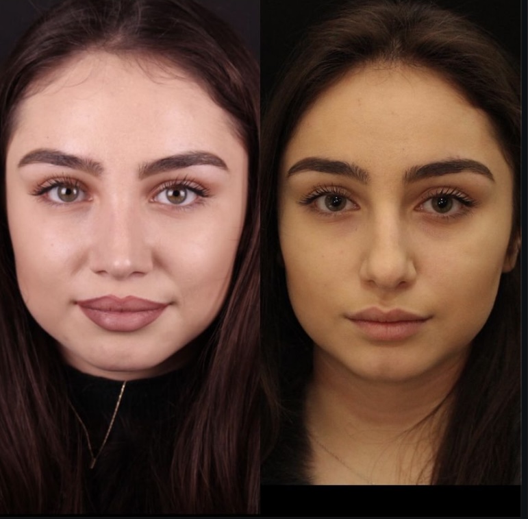 Септопластика