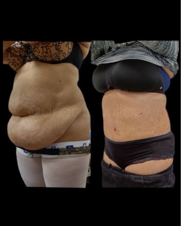 Абдоминопластика Краснодар