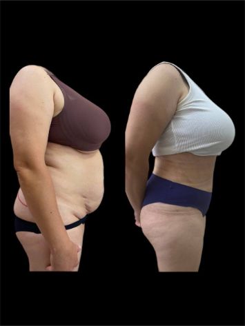 Липосакция живота Краснодар