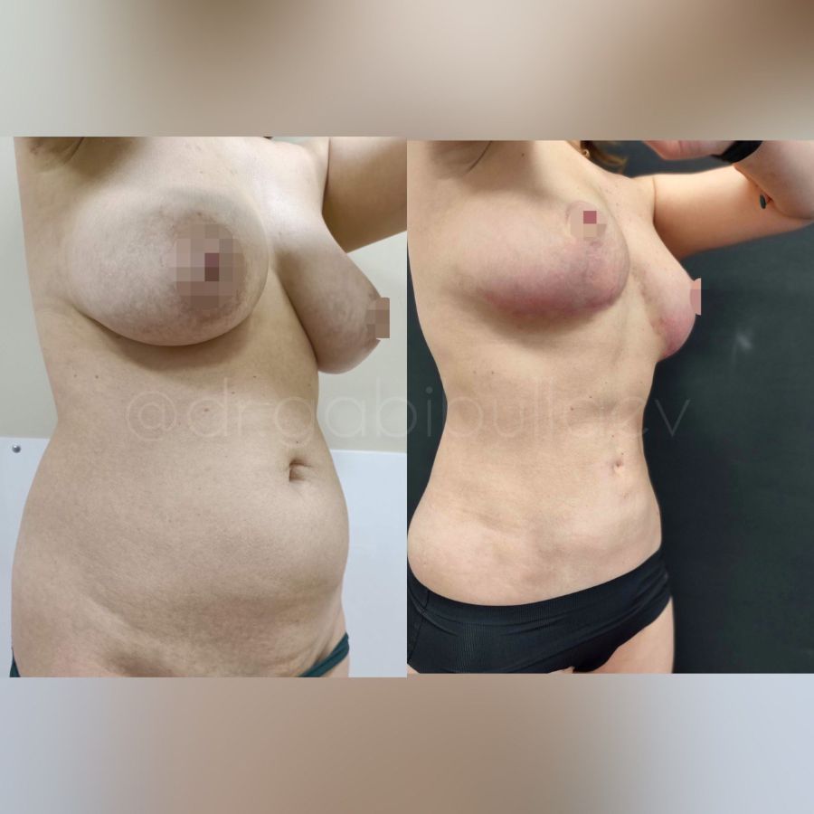 Липосакция живота подтяжка груди