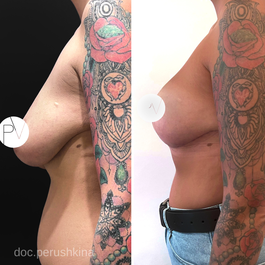 Маммопластика