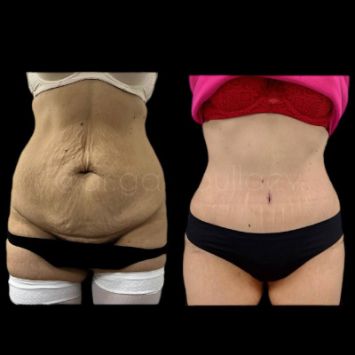 Пластика живота, абдоминопластика