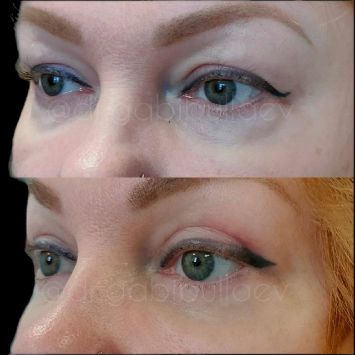 Круговая блефаропластика