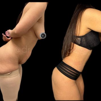 Абдоминопластика Краснодар