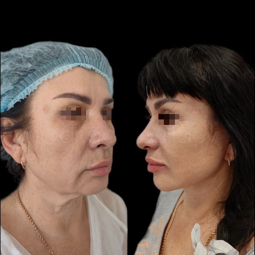 Круговая полтяжка лица и шеи