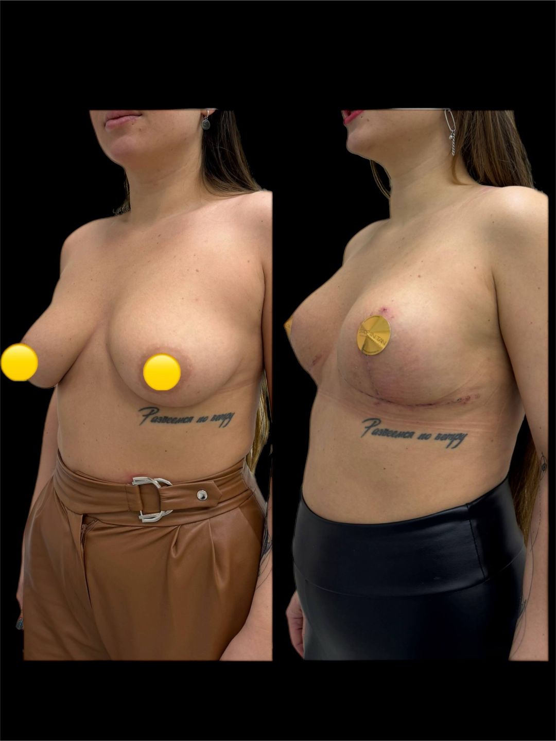 Подтяжка груди без имплантов Краснодар