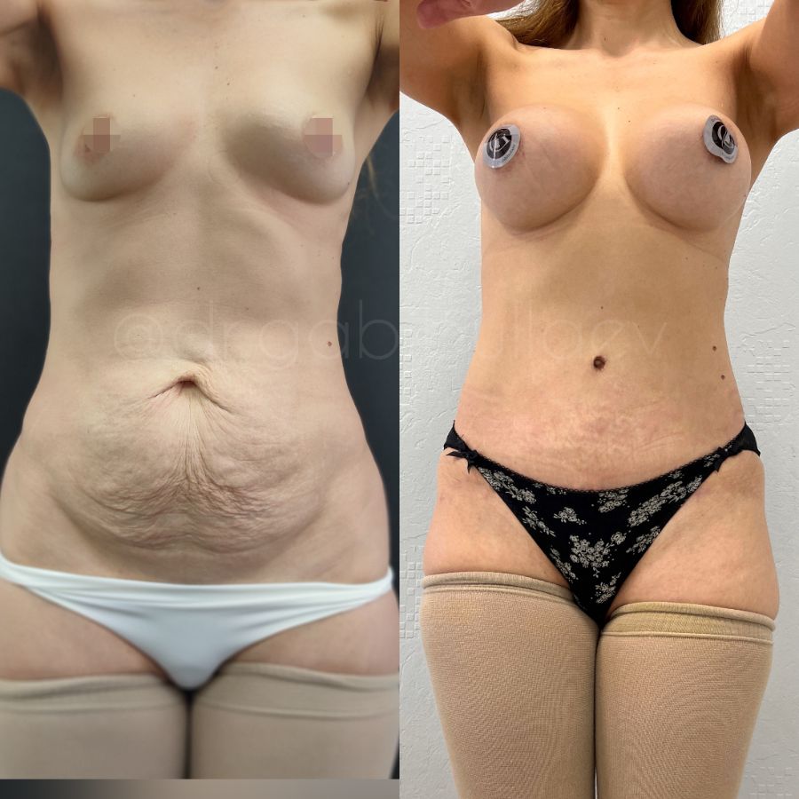 Увеличение груди имплантами