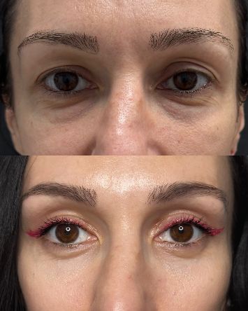 Круговая блефаропластика Краснодар