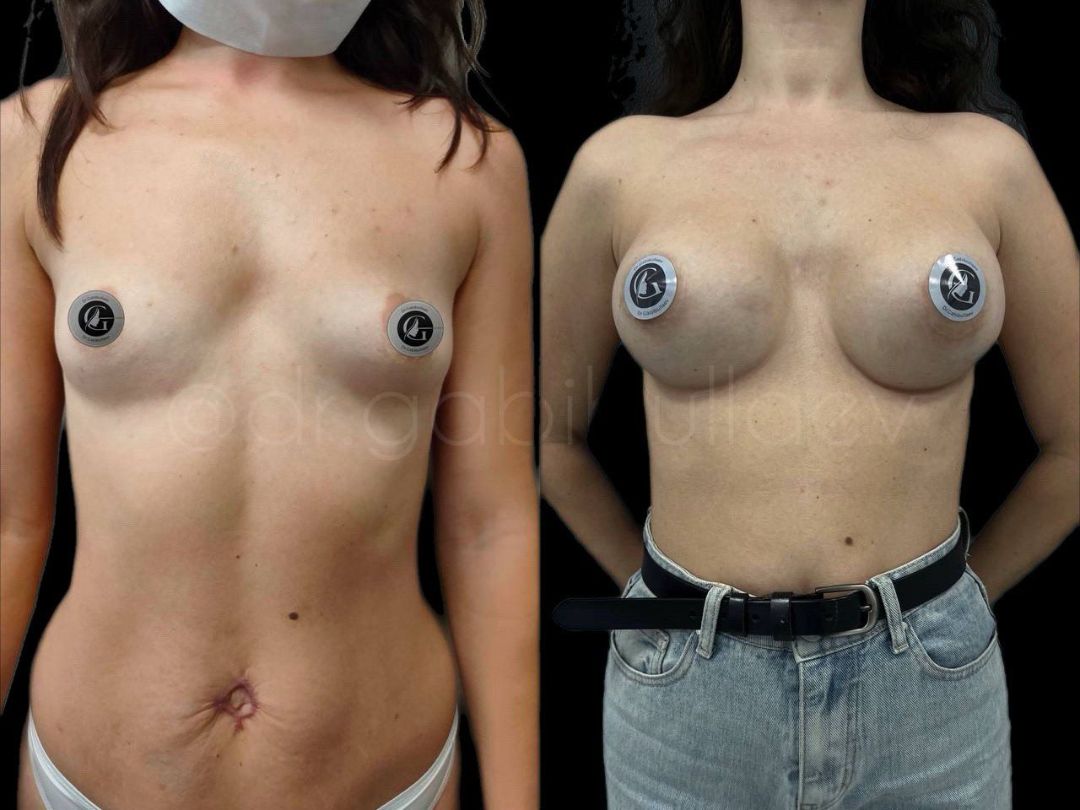 Увеличение груди имплантатами