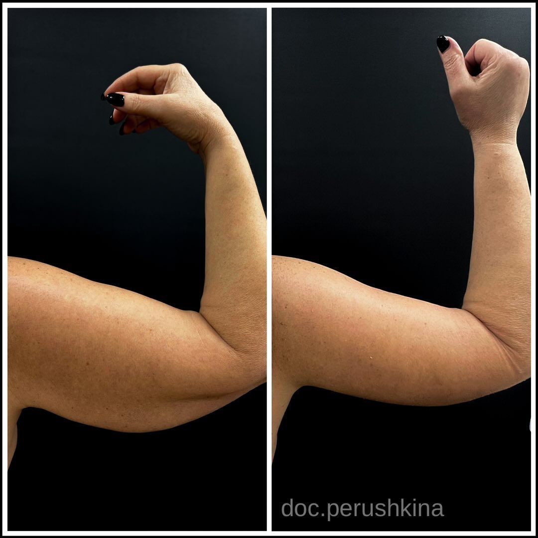 Брахиопластика