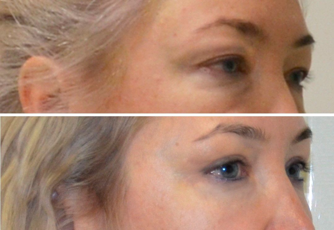 Фейслифтинг