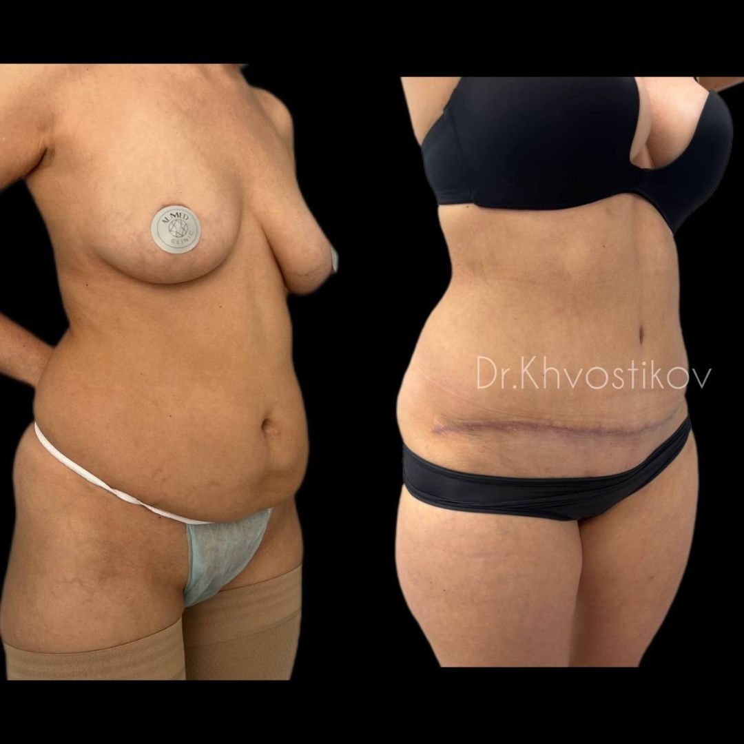 Липоабдоминопластика липосакция живота абдоминопластика